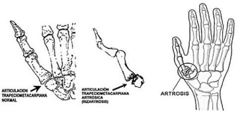 Mano artritis pulgar